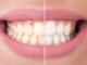 Was tun gegen gelbe Zähne?