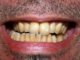 Eine Zahnverfärbung sorgt für viele Menschen für ein psychologisches Problem, jedes Lächeln wird versteckt