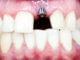 Das sollte man über Zahnimplantate wissen